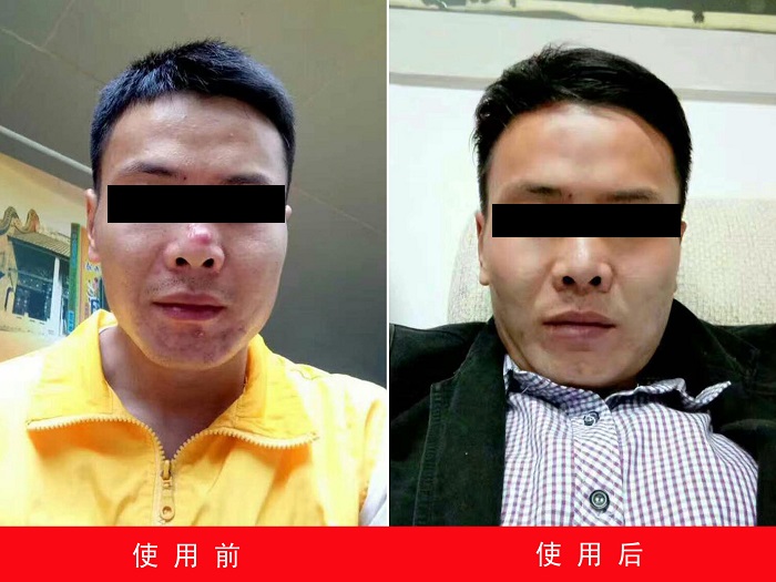 中州藥膏使用前后對比