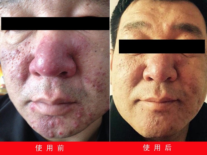 中州藥膏使用前后對比